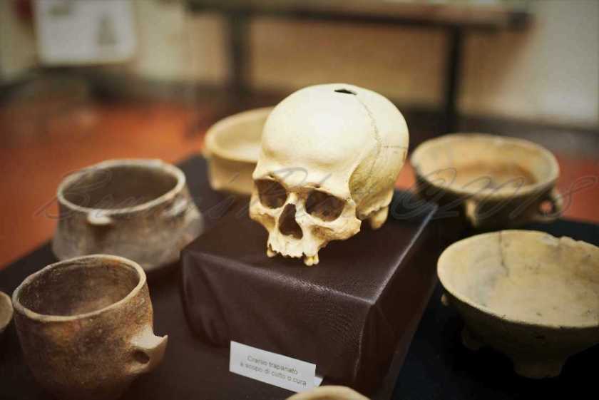 Cranio Trapanato dell'età del bronzo - Museo Archeologico di Sassari